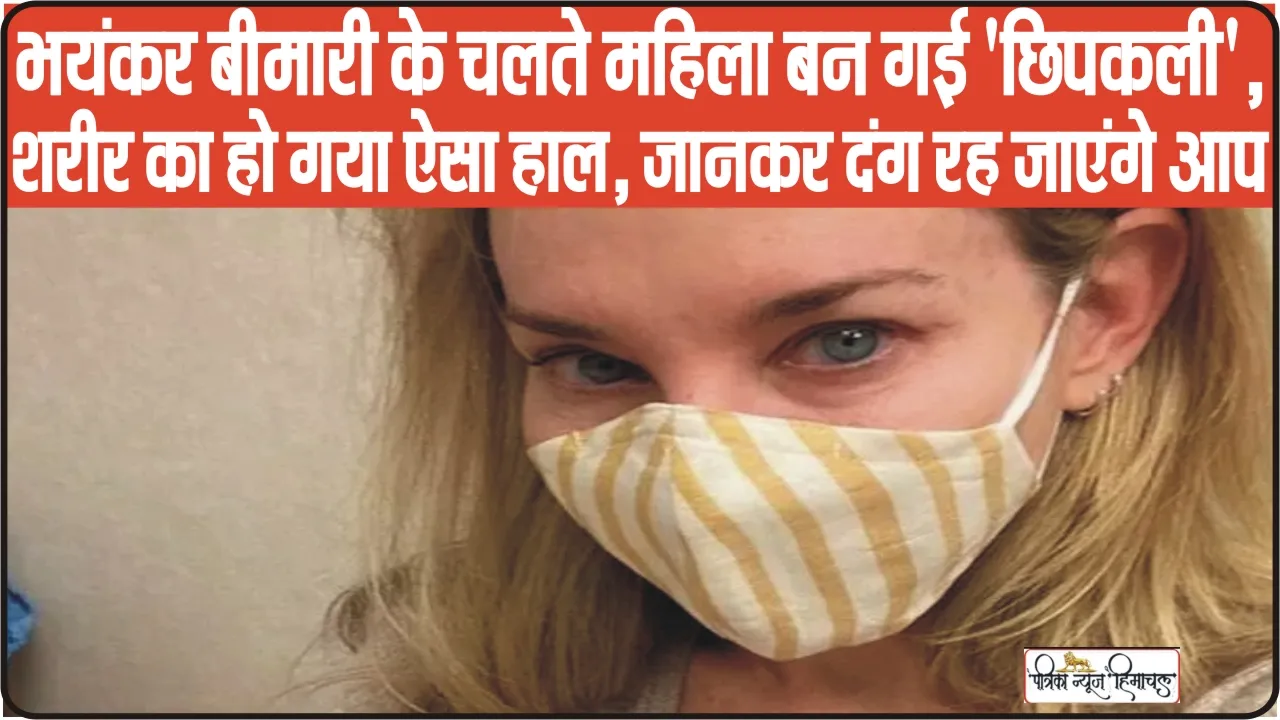 Woman skin look like lizard || सोकर उठते ही 'छिपकली' बनी महिला! शरीर पर आ गए अजीबोगरीब निशान, डॉक्टरों ने जब बताया कारण तो उड़े होश!